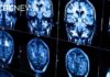New guidelines urge doctors to treat heart and brain health