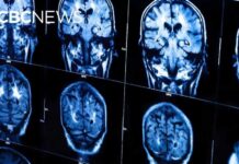 New guidelines urge doctors to treat heart and brain health