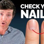 The Thyroid Nail Test That Doctors Miss
