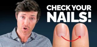 The Thyroid Nail Test That Doctors Miss