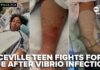 Flesh-Eating Threat Lurks in Florida Bayou Niceville teen fights for life after Vibrio infection linked to Lions Park waters