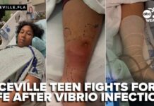 Flesh-Eating Threat Lurks in Florida Bayou Niceville teen fights for life after Vibrio infection linked to Lions Park waters