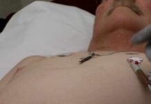AI-ECG helps physicians detect hidden heart condition