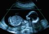 Built-In Arthritis? Womb Clue Stuns Doctors Fetal ultrasound scan image