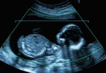 Fetal ultrasound scan image