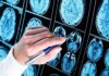 New “Immune Organ” Found – Right Inside the Skull Hand with pen pointing at brain MRI scans