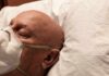 How doctors determine what stage of cancer you have Elderly man wearing a face mask resting on a pillow