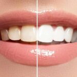 Close-up smile showing before-and-after teeth whitening