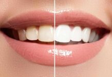 Close-up smile showing before-and-after teeth whitening