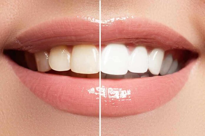 Close-up smile showing before-and-after teeth whitening